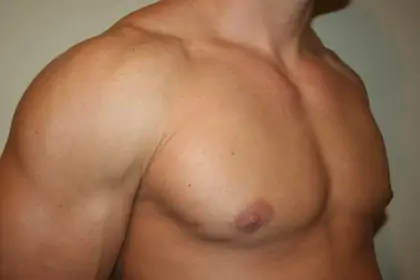 Gynecomastia Before & After Patient #12585