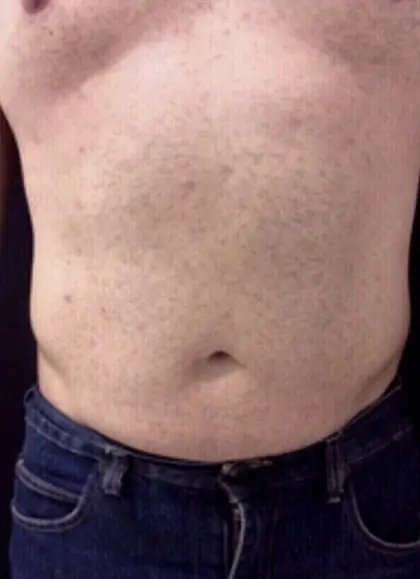 Liposuction Before & After Patient #13942