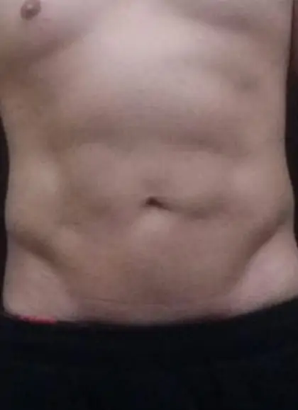 Liposuction Before & After Patient #13942
