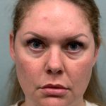 Facelift Before & After Patient #85721