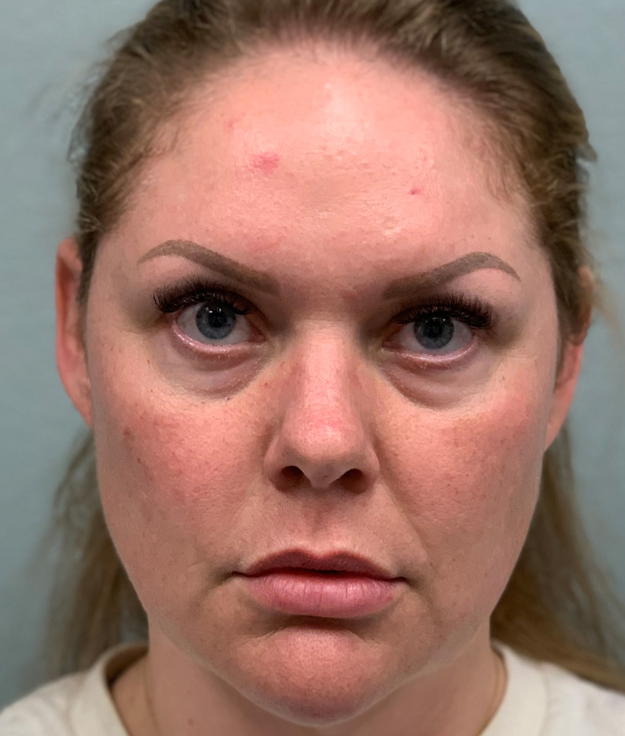 Facelift Before & After Patient #85721