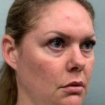 Facelift Before & After Patient #85721