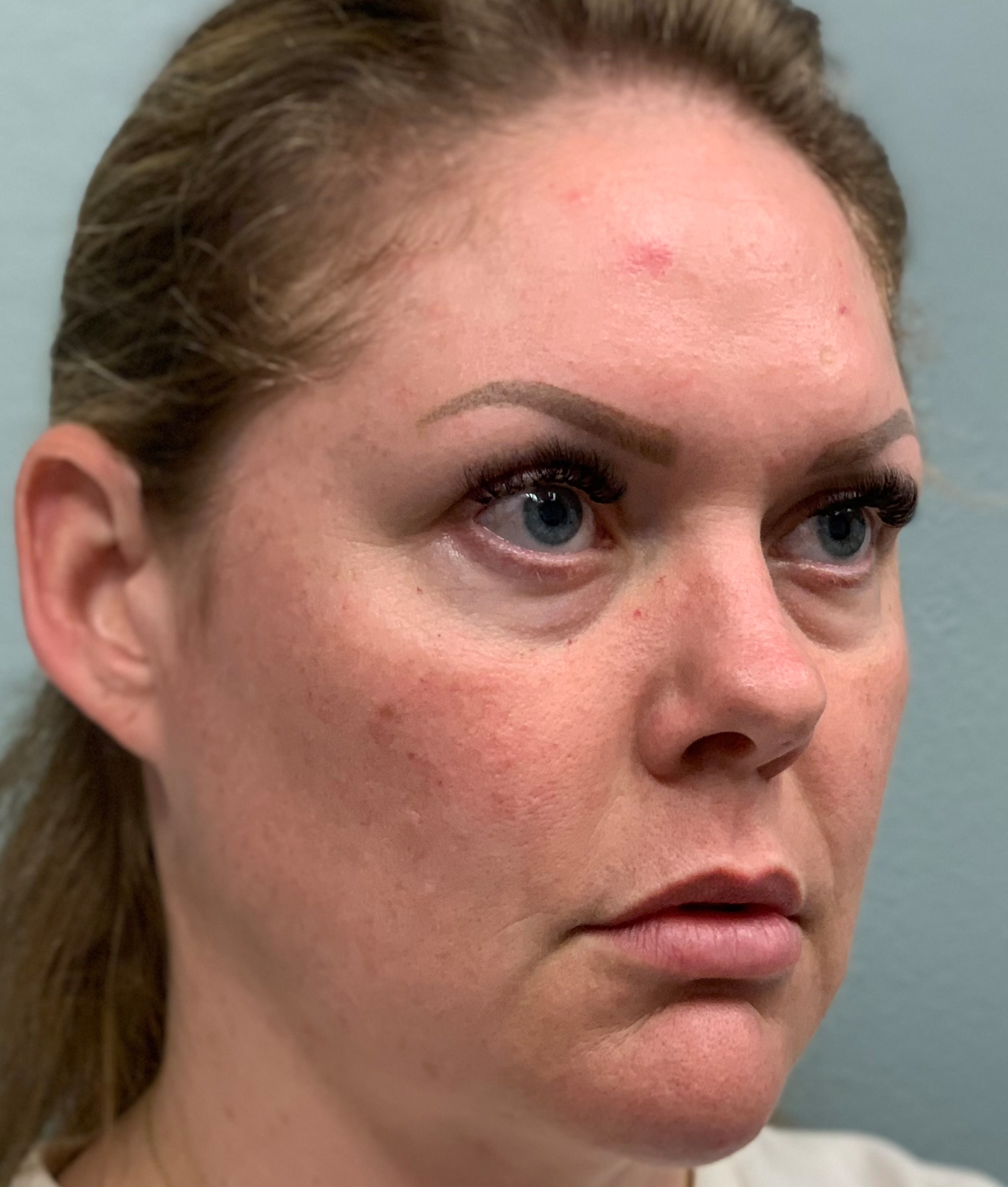 Facelift Before & After Patient #85721