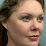 Facelift Before & After Patient #85721