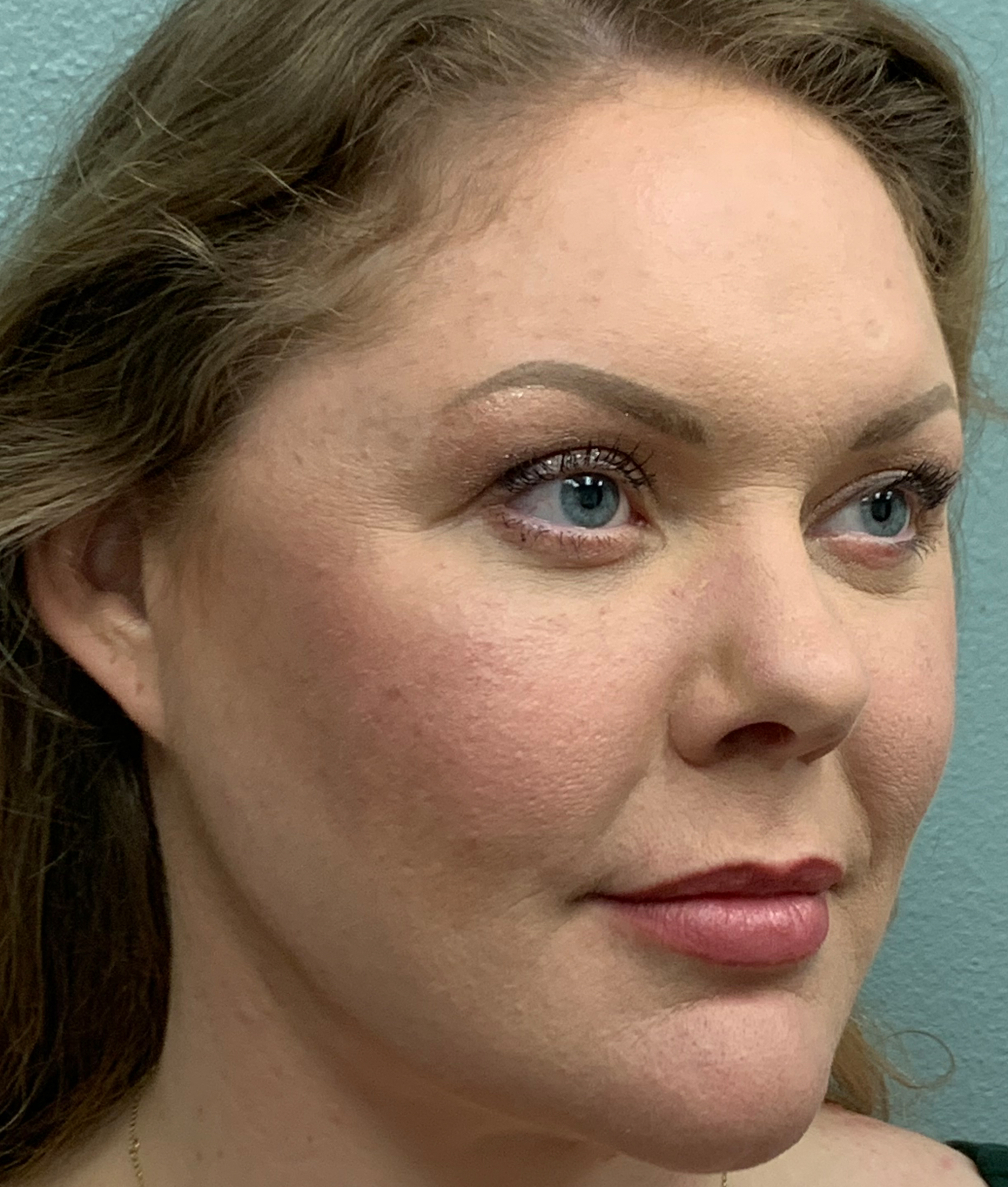 Facelift Before & After Patient #85721
