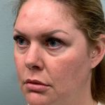 Facelift Before & After Patient #85721