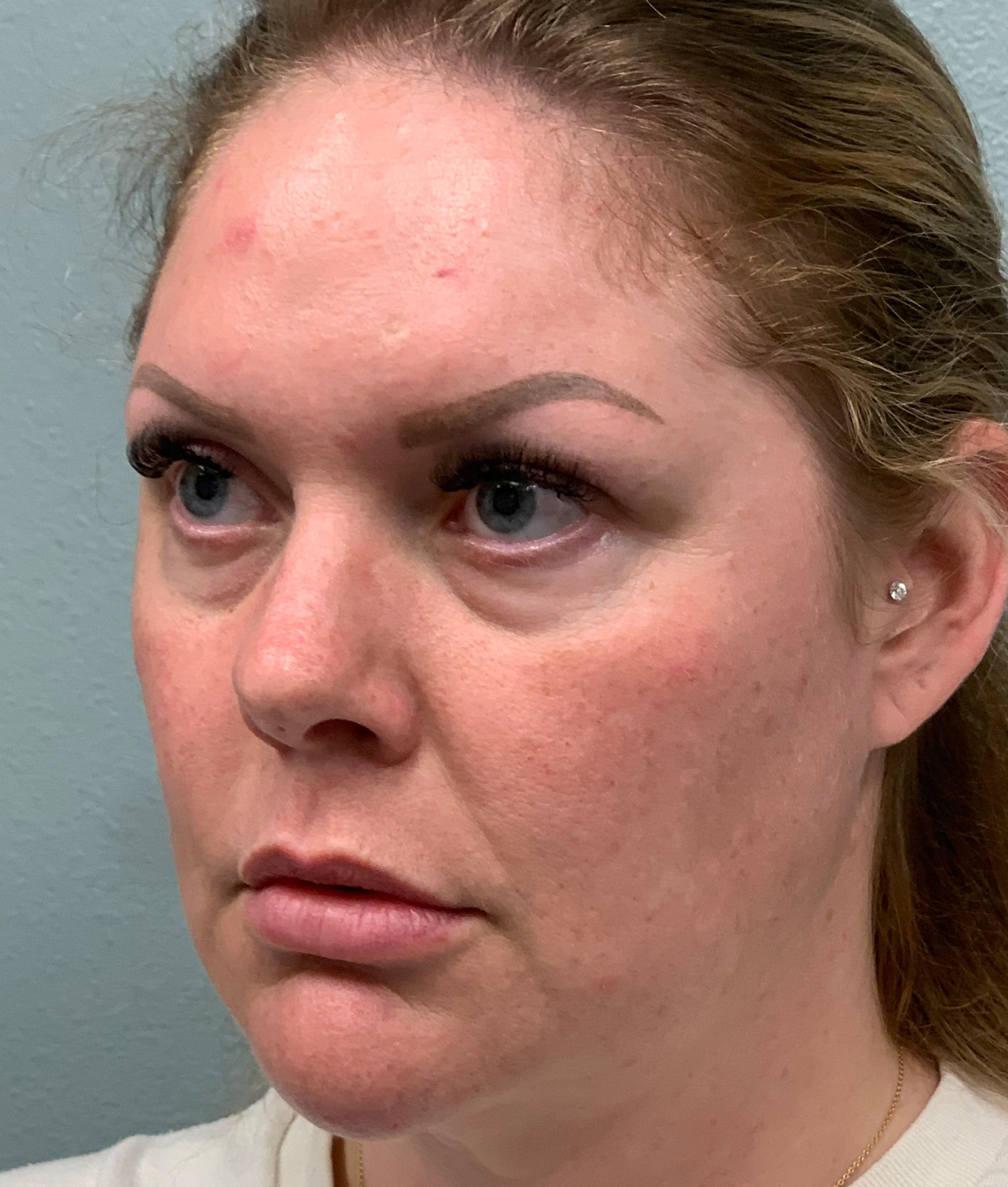 Facelift Before & After Patient #85721