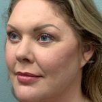 Facelift Before & After Patient #85721