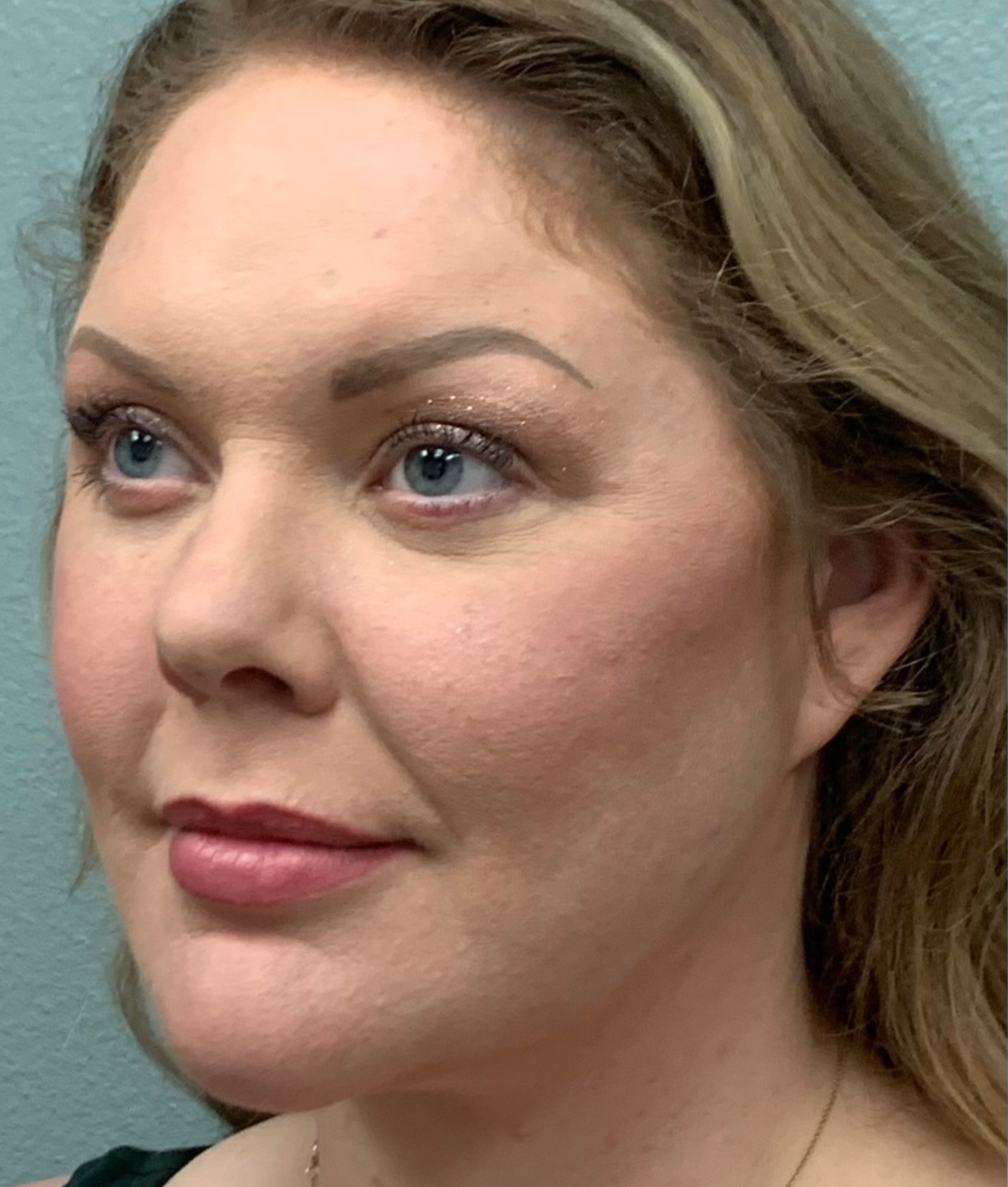 Facelift Before & After Patient #85721