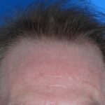 Hair Transplant Before & After Patient #17101