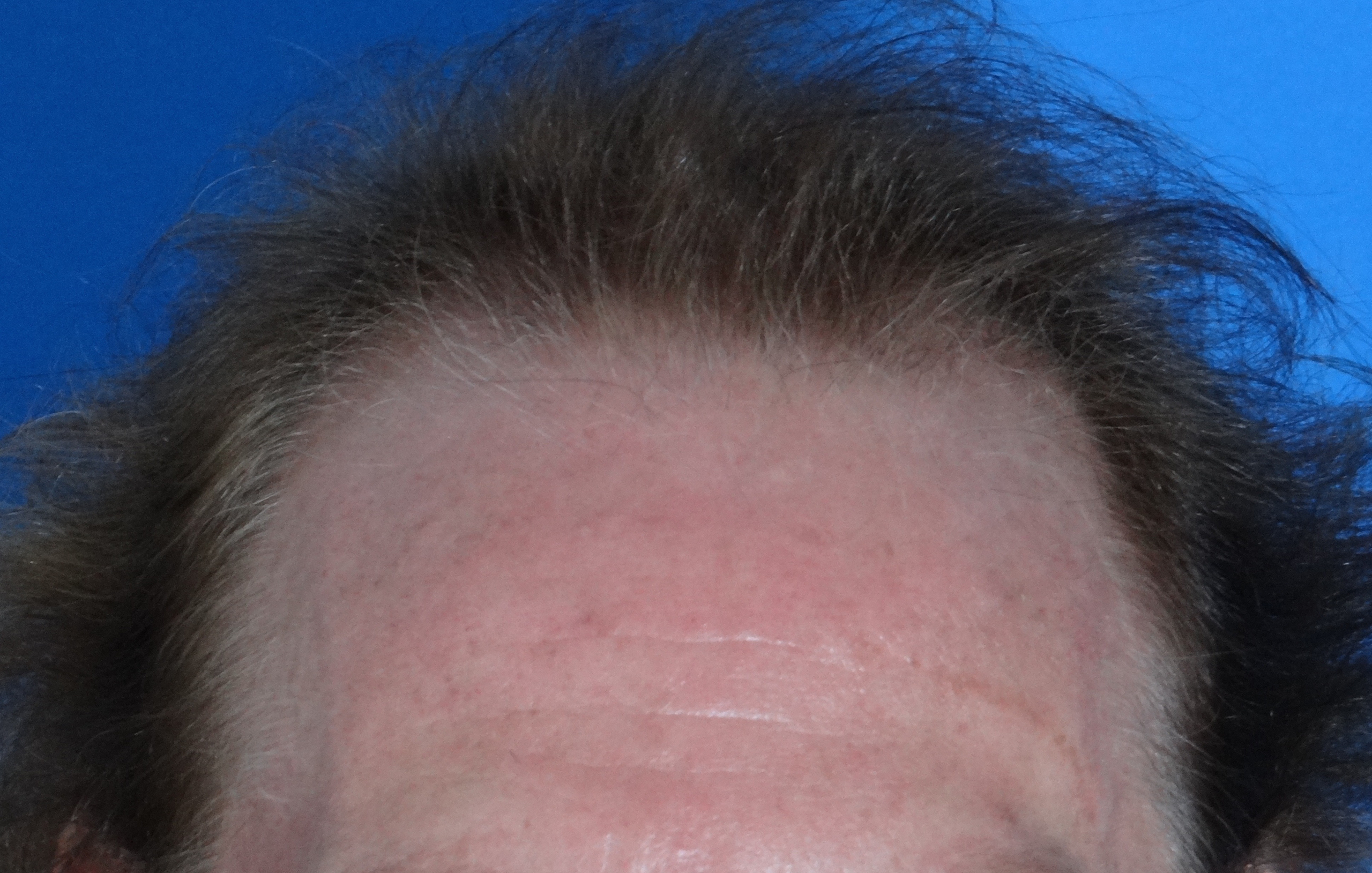 Hair Transplant Before & After Patient #17101