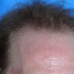 Hair Transplant Before & After Patient #17101