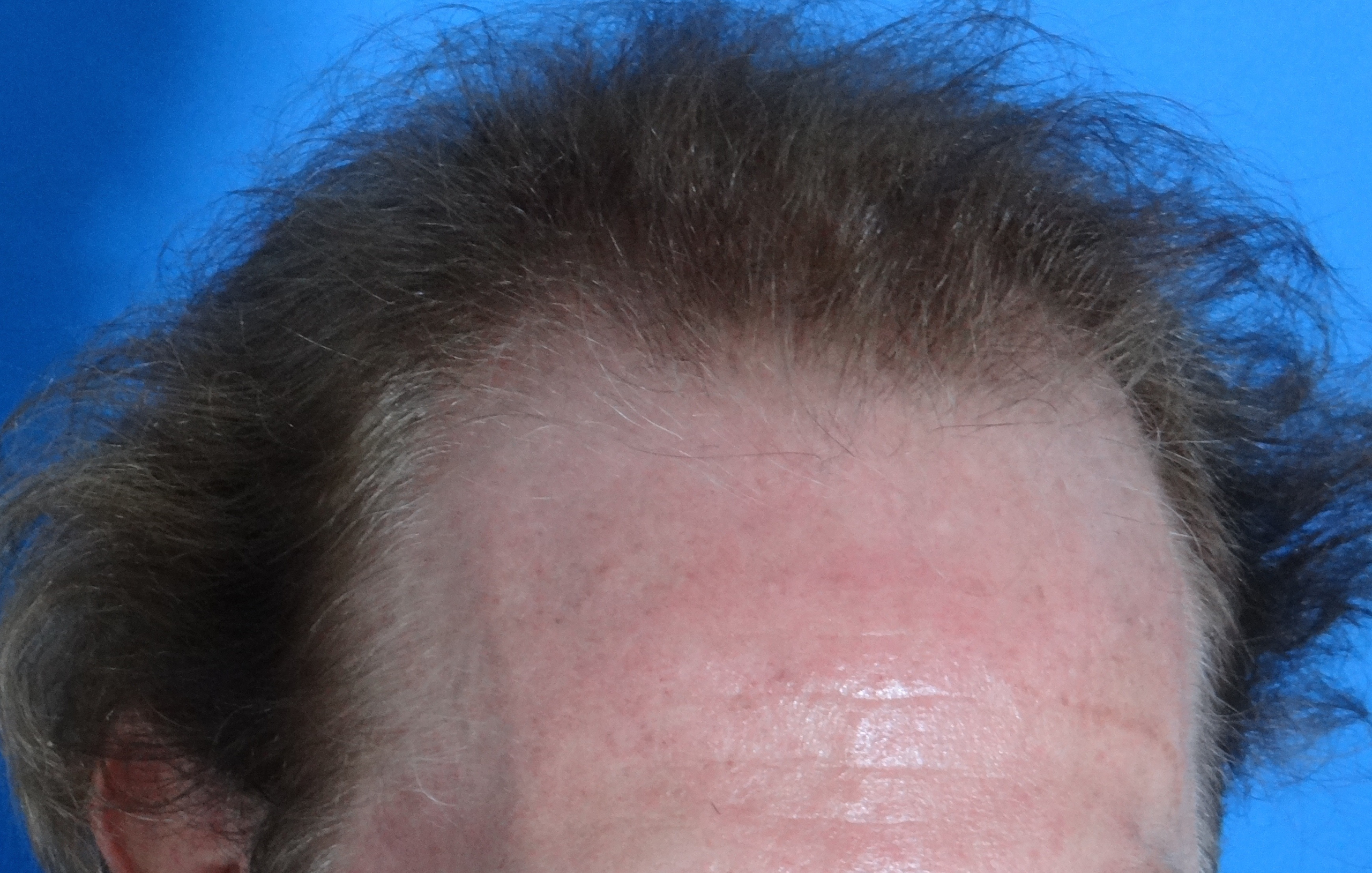 Hair Transplant Before & After Patient #17101