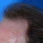Hair Transplant Before & After Patient #17101