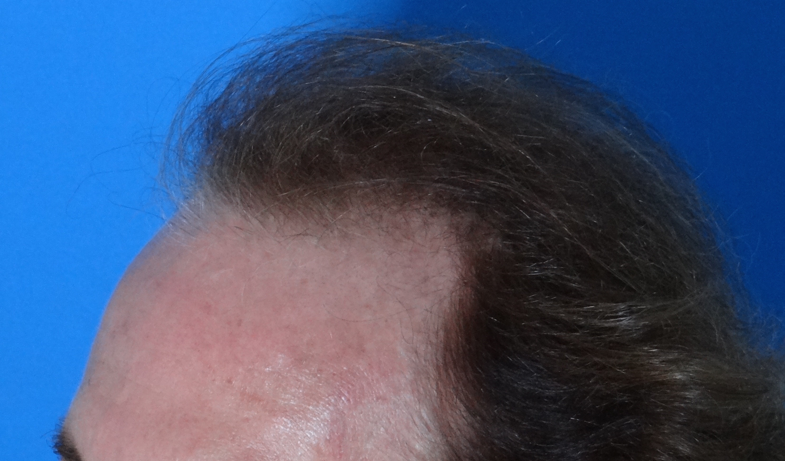 Hair Transplant Before & After Patient #17101