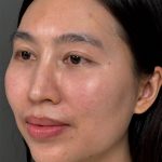 Fat Transfer (Fat Grafting) Before & After Patient #9755