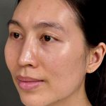 Fat Transfer (Fat Grafting) Before & After Patient #9755