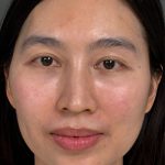 Fat Transfer (Fat Grafting) Before & After Patient #9755