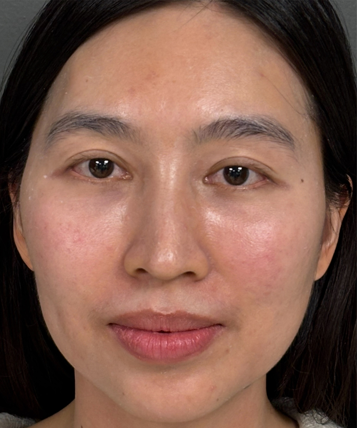 Blepharoplasty Before & After Patient #9755