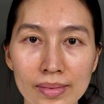 Fat Transfer (Fat Grafting) Before & After Patient #9755