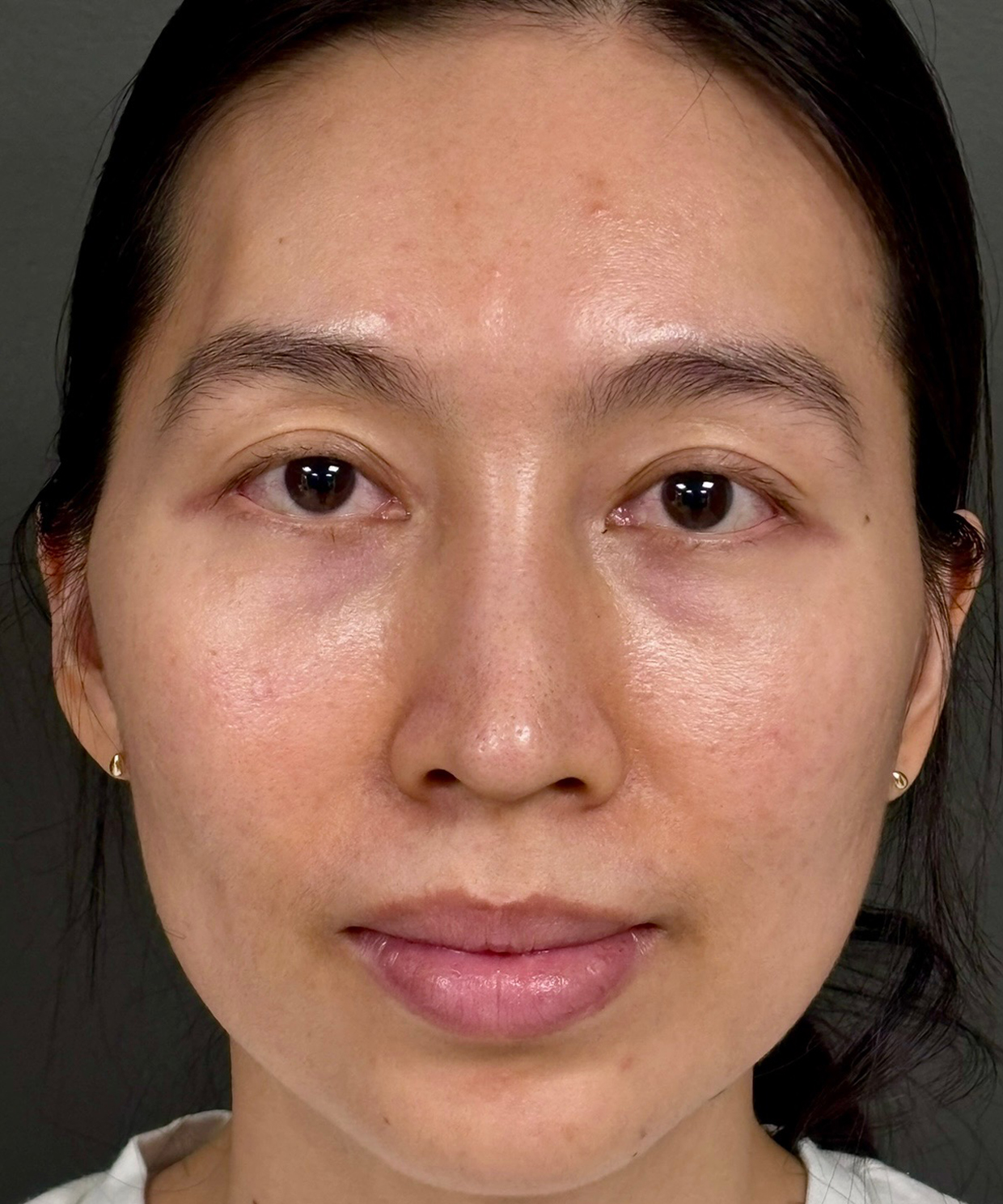 Blepharoplasty Before & After Patient #9755