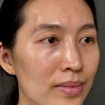 Fat Transfer (Fat Grafting) Before & After Patient #9755